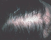 androgen_alopeci